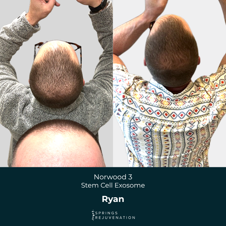 Ryan - Before & After